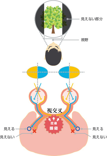 optic_chiasm